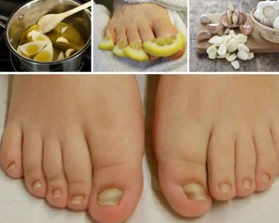Folk remedies for nail fungus