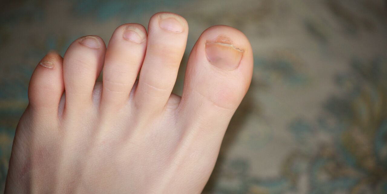 toe nail fungus