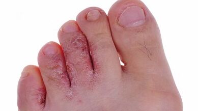 Types and stages of the development of fungus on the legs