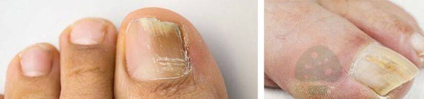 The nail fungus of the thumb on the leg