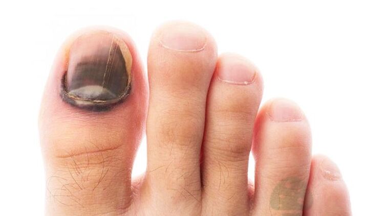 The running stage of the disease with a fungus of the nail of the thumb