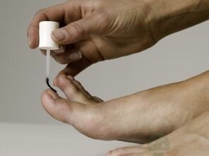 Treatment of nail fungus