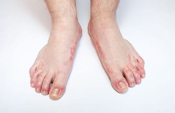 Fungal disease of the skin of the feet