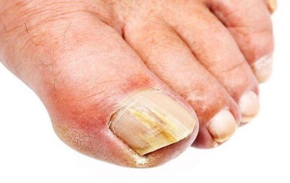 Onychomycosis - toenail fungus