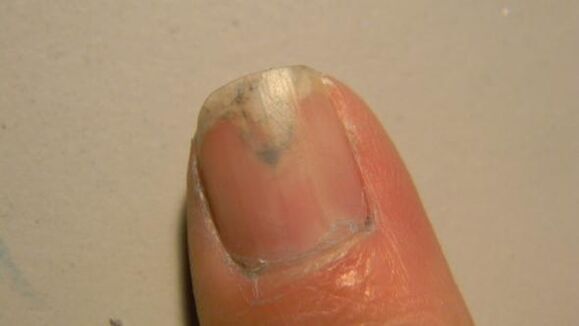 nail fungus symptoms