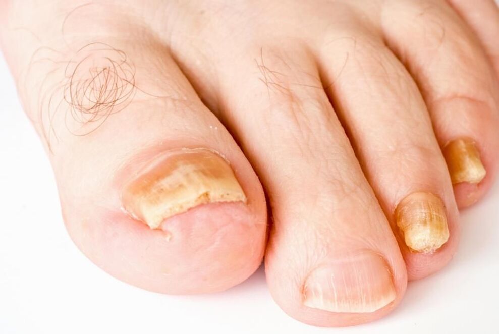 toenail fungus