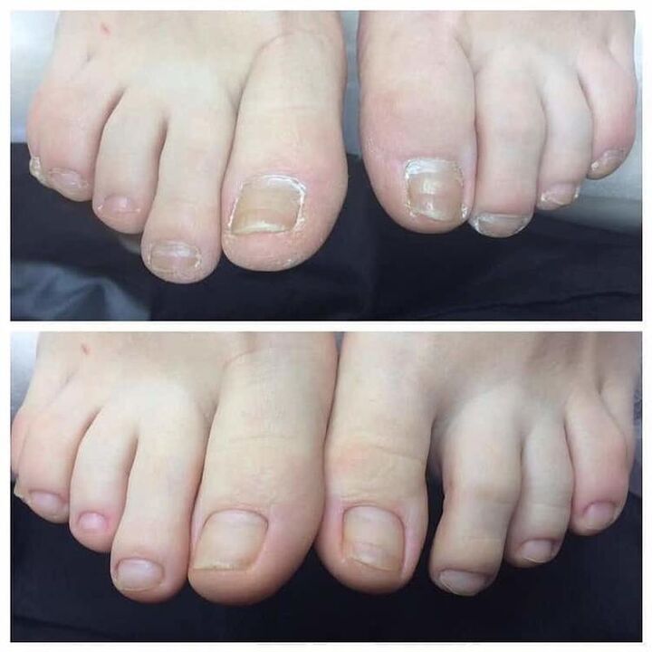 review of use Exodermin